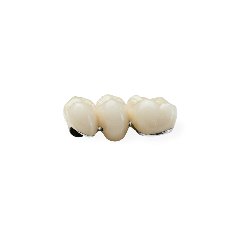 PFM Non-Precious Bridge