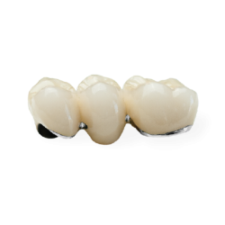 PFM Non-Precious Bridge