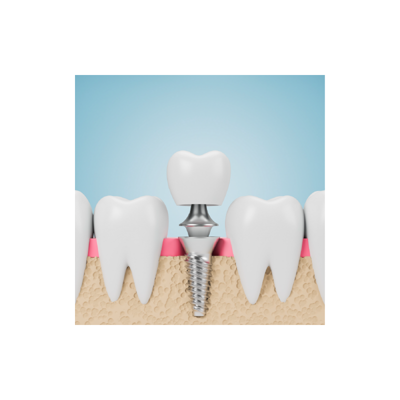 Implant & PFM Non-Precious Crown