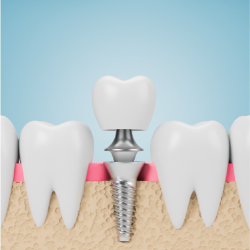 Implant & IPS e.max (layered) Crown