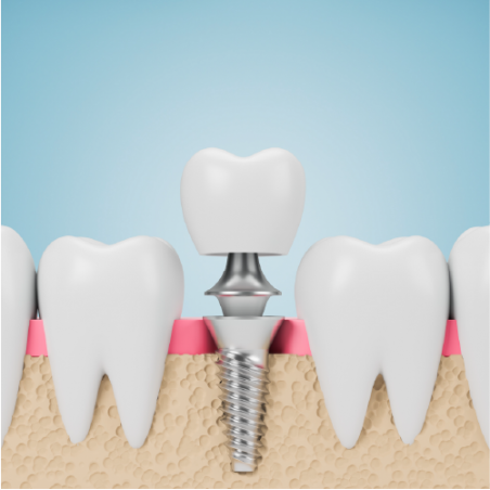 Implant & IPS e.max (layered) Crown