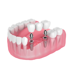 Implant Bridge