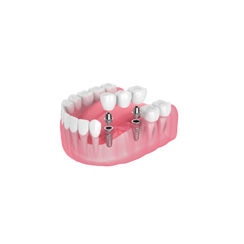 Implant Bridge