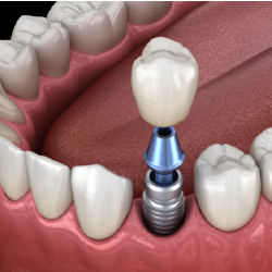 Implant & FMZ (monolithic) Crown