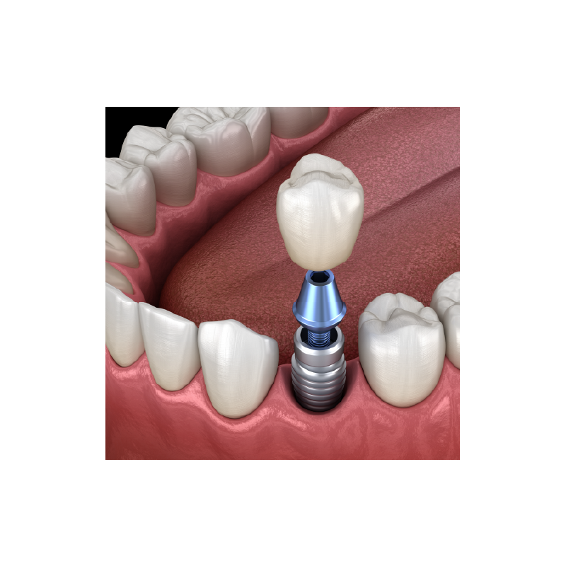 Implant & FMZ (monolithic) Crown