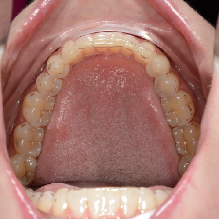 Hercules Retainer