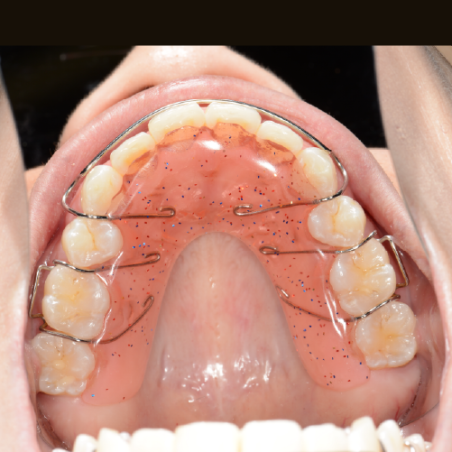 Hawley Retainer