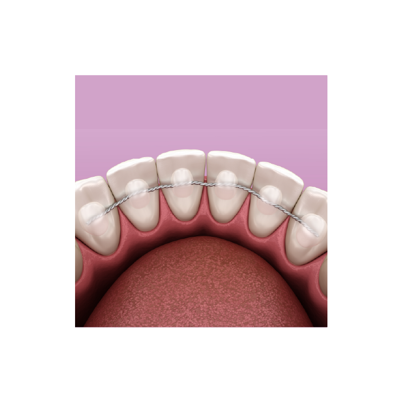 Fixed Wire Retainer