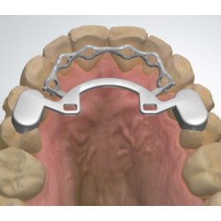 Infinity Fixed Lingual Retainer (Upper)