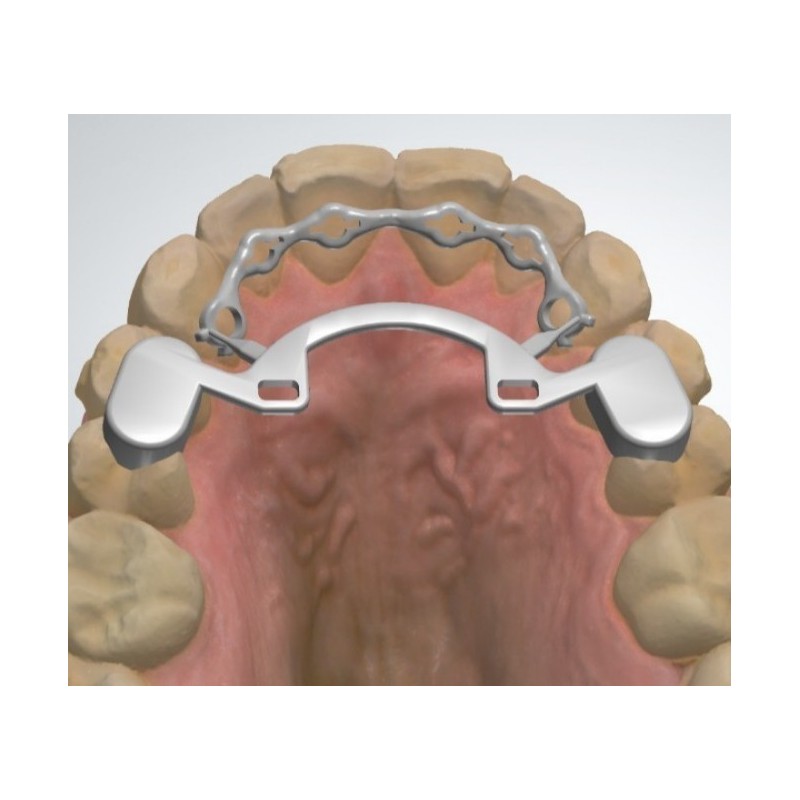 Infinity Fixed Lingual Retainer (Upper)