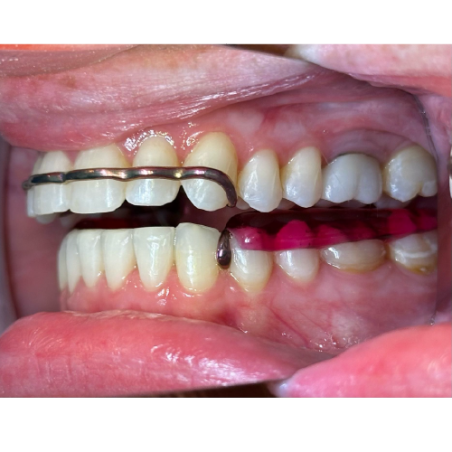 Atlas Retainer Set - Titanium