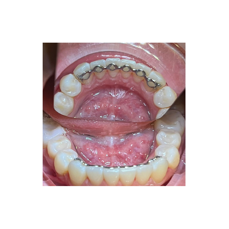 Infinity Fixed Lingual Retainer (Upper & Lower set) - Titanium
