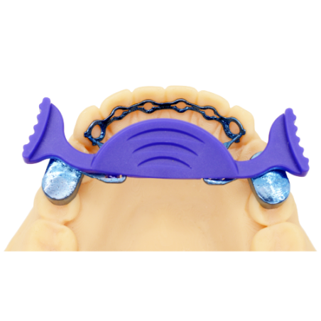 Infinity Fixed Lingual Retainer (Upper & Lower set) - Cobalt Chromium