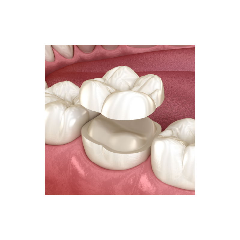 Lithium Disilicate Onlay