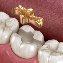 High-Precious (70% Gold) Inlay