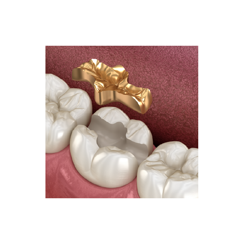 High-Precious (70% Gold) Inlay