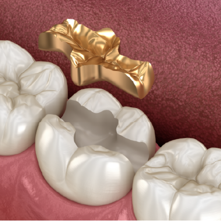 High-Precious (70% Gold) Inlay
