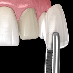 Zirconia Veneer