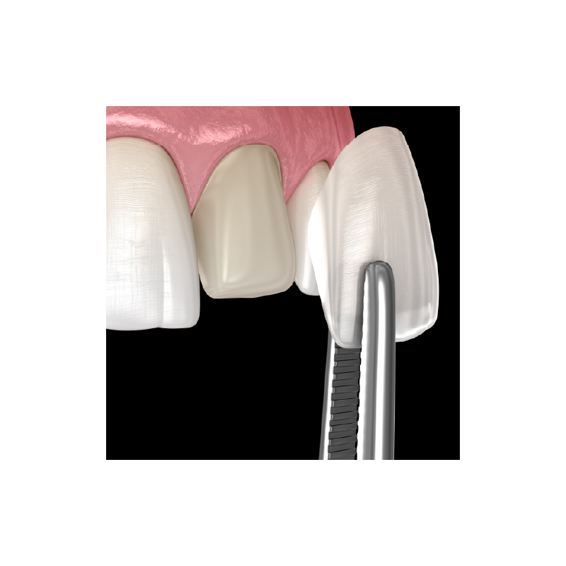 Zirconia Veneer