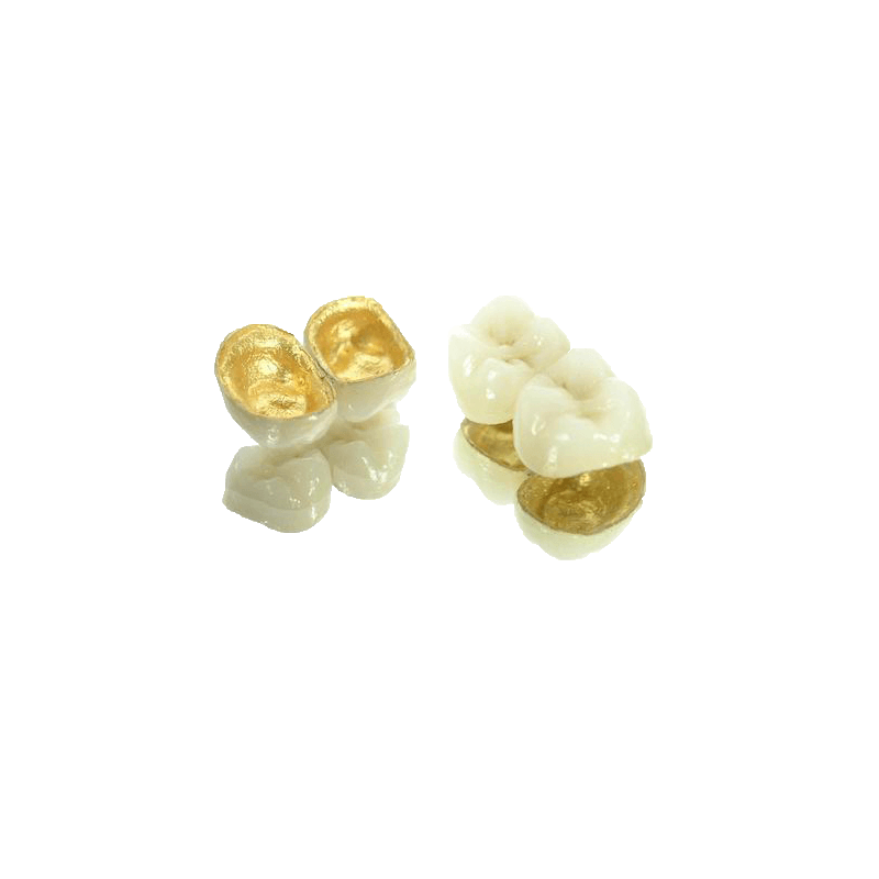 PFM High-Precious Metal Crown (75% Gold)