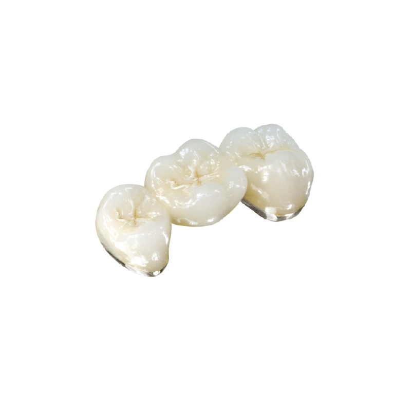 PFM High-Precious Metal Crown (40% Gold)