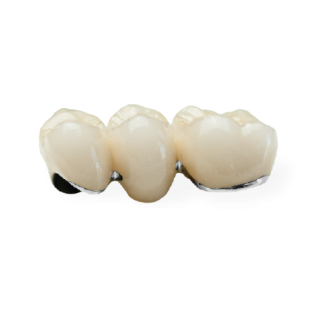 PFM Non-Precious Bridge