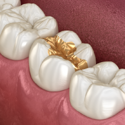 High-Precious (70% Gold) Onlay