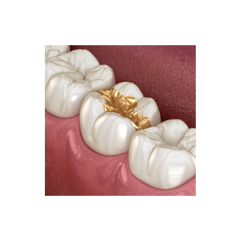 High-Precious (70% Gold) Onlay