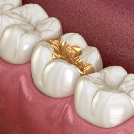 High-Precious (70% Gold) Onlay